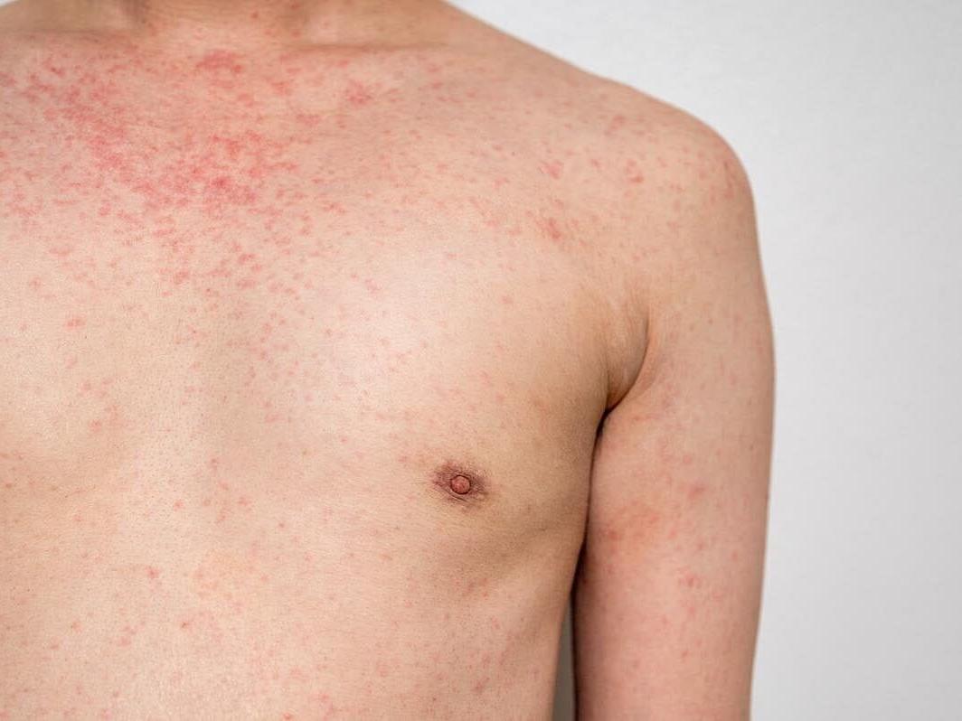 5,000+ Measles Cases Threaten Canada’s Elimination Status